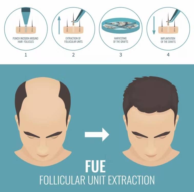 Fue Hair Implantaat Micro Moto - Hair Care Basic recensie en prijs